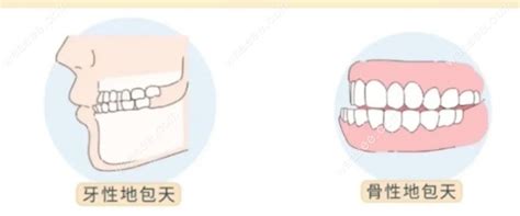 地包天牙齒|地包天是骨性还是牙性？一文教你轻松了解分类、判断。